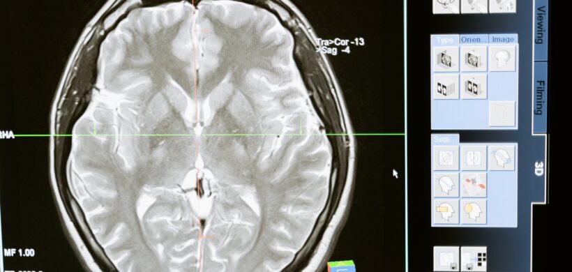 Atrofia cortical posterior: Enfoque neurooftalmológico